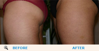 Mary reduced cellulite on her thigs just in one month